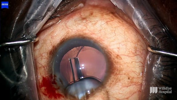Zonulopathy in Primary Angle-Closure Disease thumbnail