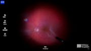 Subretinal Bands in the Macula