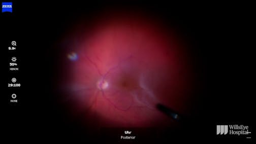 Subretinal Bands in the Macula