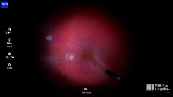 Subretinal Bands in the Macula thumbnail