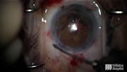 Traumatic Cataract With Repeat Pupillary Cerclage Under a Penetrating Keratoplasty