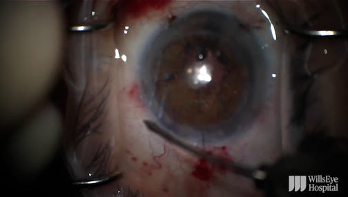 Traumatic Cataract With Repeat Pupillary Cerclage Under a Penetrating Keratoplasty