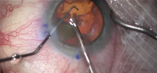 Vertical Chop Techniques