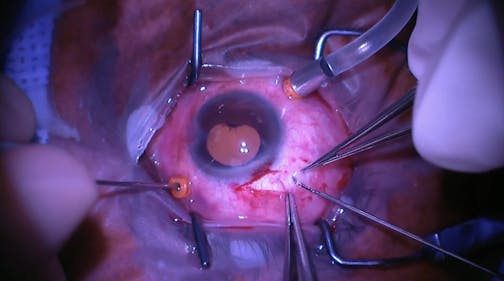 Retinal and Subretinal Biopsy Lymphoma