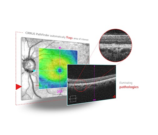 Zeiss to Showcase Expansion of Ophthalmic Care Options; New Refractive and Cataract Milestones at ESCRS