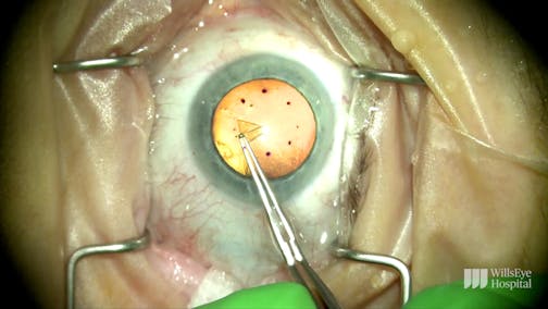 Performing Descemet Stripping Only to Treat Fuchs Endothelial Dystrophy