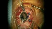 Suture Handshake Technique With Scleral Fixation Forceps