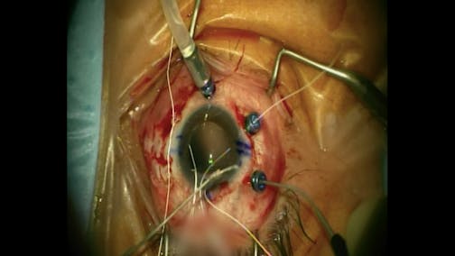 Suture Handshake Technique With Scleral Fixation Forceps