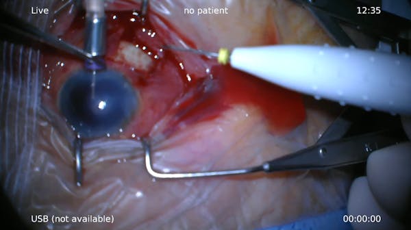 Choroidal Hemorrhage thumbnail