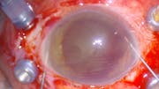Hyphema Washout