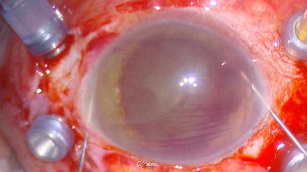 Hyphema Washout thumbnail