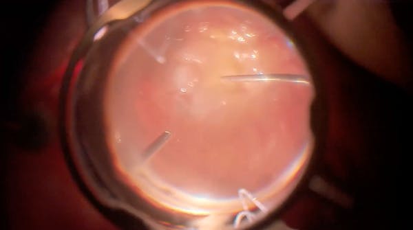 PVR Surgery & Dye Injection thumbnail