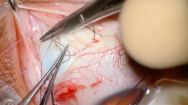 Scleral Buckling thumbnail