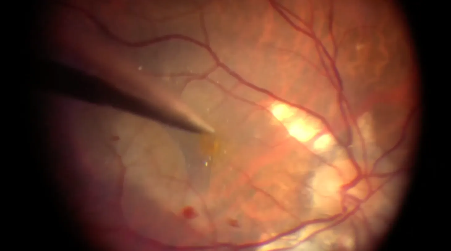 Macular Hole & Retinal Detachment - Eyetube