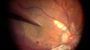 Macular Hole & Retinal Detachment