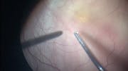 Infantile Macular Hole & Retinal Detachment