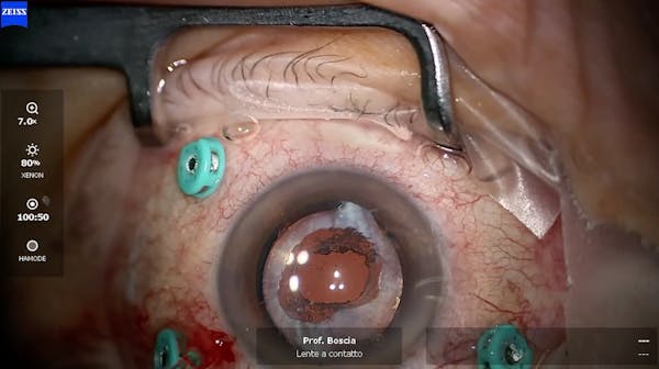 Anterior Capsulectomy thumbnail