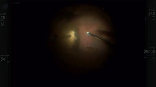Vitreous Hemorrhage in a 3-Month-Old Patient