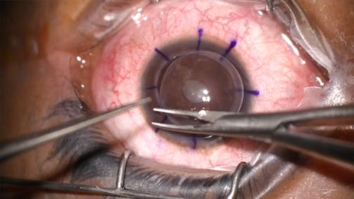 Corneal Transplant Using Ayres Needle Holder Scissors