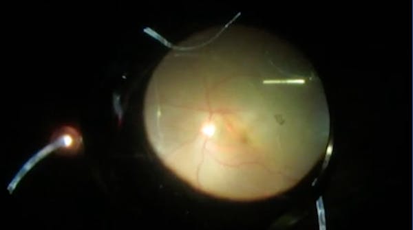 Subretinal Membrane thumbnail