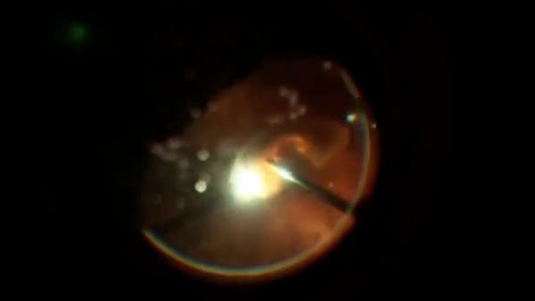 Dense Cataract thumbnail