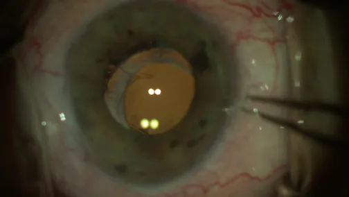 Dislocated Toric IOL in an Eye With a Large, Functioning Bleb After Trabeculectomy.  Now What?