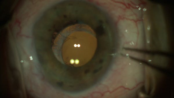 Dislocated In-the-Bag Toric IOL After Trabeculectomy thumbnail