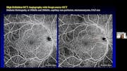 OCT-A Imaging to Identify Proliferative Diabetic Retinopathy