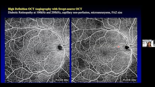 OCT-A Imaging to Identify Proliferative Diabetic Retinopathy