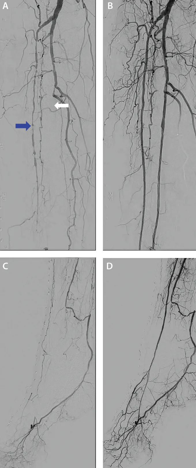 Figure 3. Baseline angiography of right BTK arteries (A) and of the distal pedal vessels (C) showing a totally occluded right AT artery (blue arrow, A) and totally occluded right peroneal artery (white arrow, A). Postintervention angiography showing re-establishment of two-vessel runoff to the periphery (B, D).