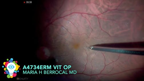 Improving Visual Function in a Patient With Symptomatic Vitreous Opacities