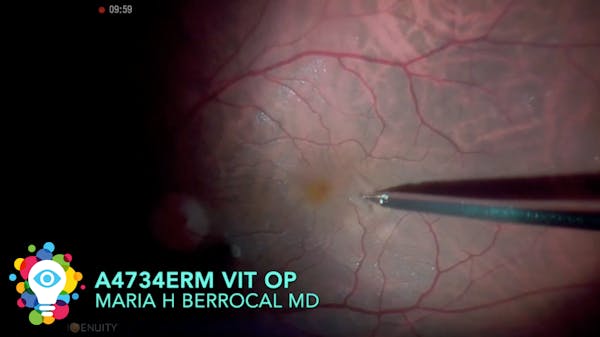 Improving Visual Function in a Patient With Symptomatic Vitreous Opactities thumbnail