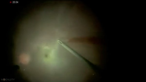 Snowflake Vitreoretinal Degeneration thumbnail
