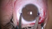 Carlevale Lens Implantation in a Child