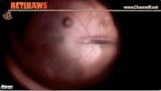 Macular Fold