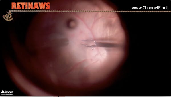 Macular Fold thumbnail