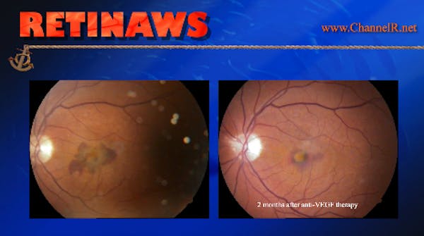 Dye Infection thumbnail