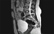 Tuberculous Radiculomyelitis image