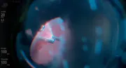 Cloudy Cornea