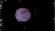 Inferiorly Stretched Macula