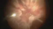 Trauma