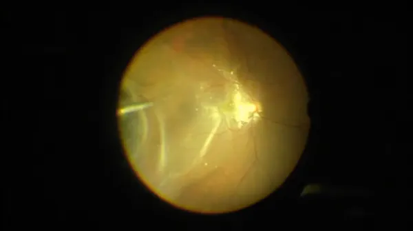 Retinoschisis Retinal Detachment thumbnail