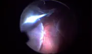 Struggling with the Choroid