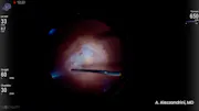 Pathologic Myopia