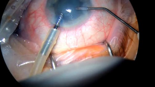 Stop-and-Chop Technique: Pseudoexfoliation, Floppy Iris, and White Hypermature Cataract