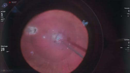 Amniotic Membrane for Optic Pit