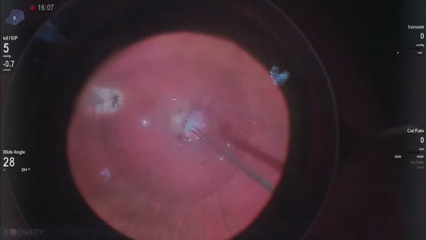 Amniotic Membrane for Optic Pit thumbnail