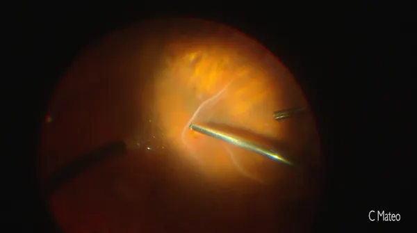 Scleral Buckling thumbnail