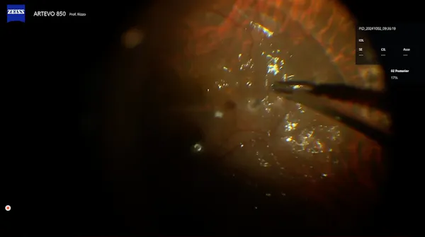 Subretinal Perfluoron thumbnail