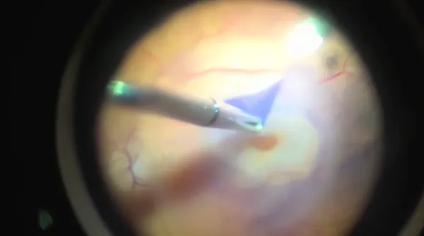 Macular Hole After ERM Peeling thumbnail